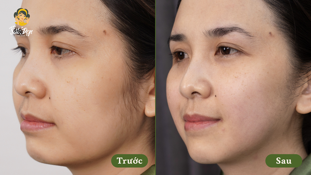 cong-nghe-density-giai-phap-tre-hoa-da-va-giup-da-san-chac