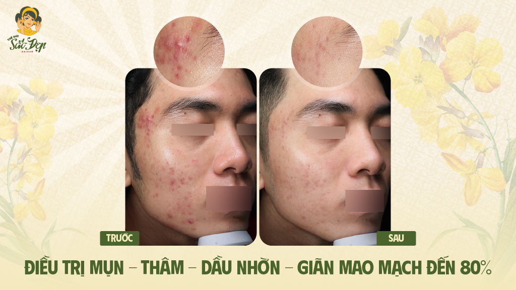 dieu-tri-mun-bang-mesoradio-hieu-qua-den-80%
