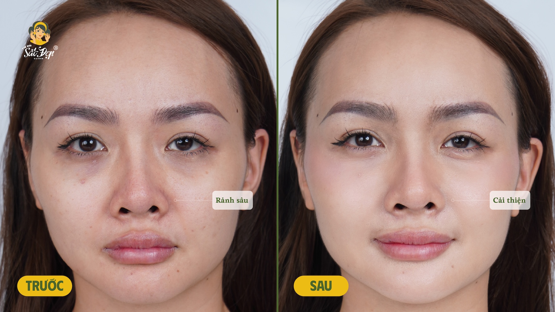 Hiệu quả của Belotero Intense trên khách hàng