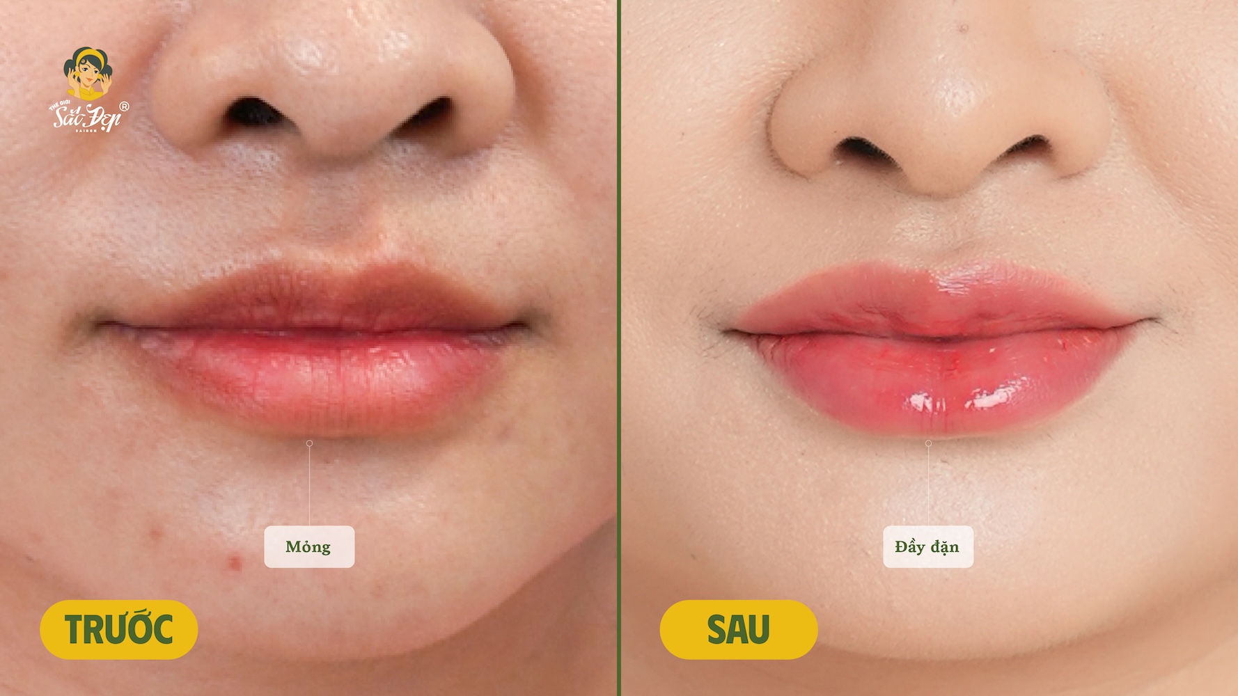 Hiệu quả của Belotero Intense trên khách hàng