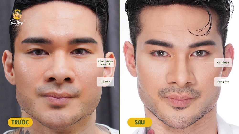 Khách hàng cải thiện ngay lập tức sau điều trị BAL