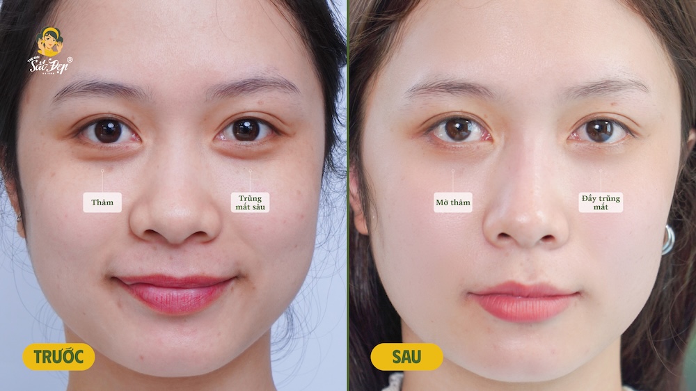 Khách hàng cải thiện ngay lập tức sau điều trị BAL
