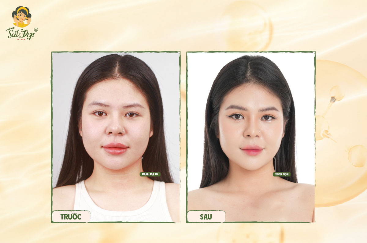 Khách hàng sau 1 tháng điều trị Ultherapy Prime