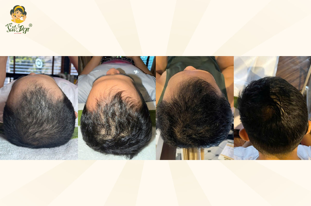 Kết quả sau 4 lần thực hiện liệu trình mọc tóc ở Thế Giới Sắc Đẹp