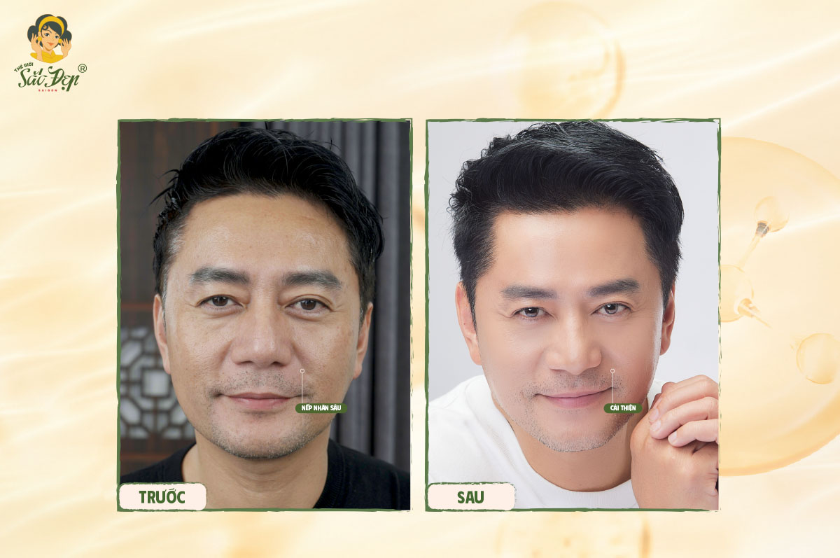 Khách hàng sau 1 tháng điều trị Ultherapy Prime
