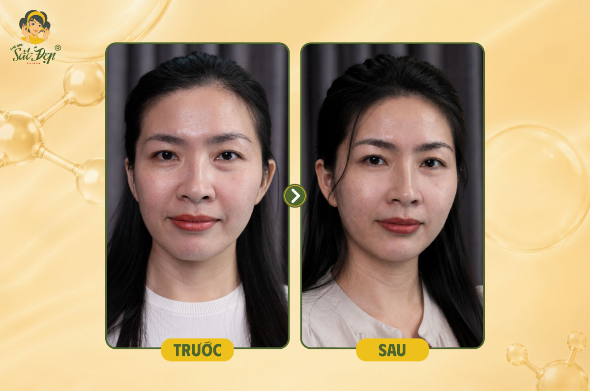 Khách hàng sau khi thực hiện Radiesse x Belotero Intense